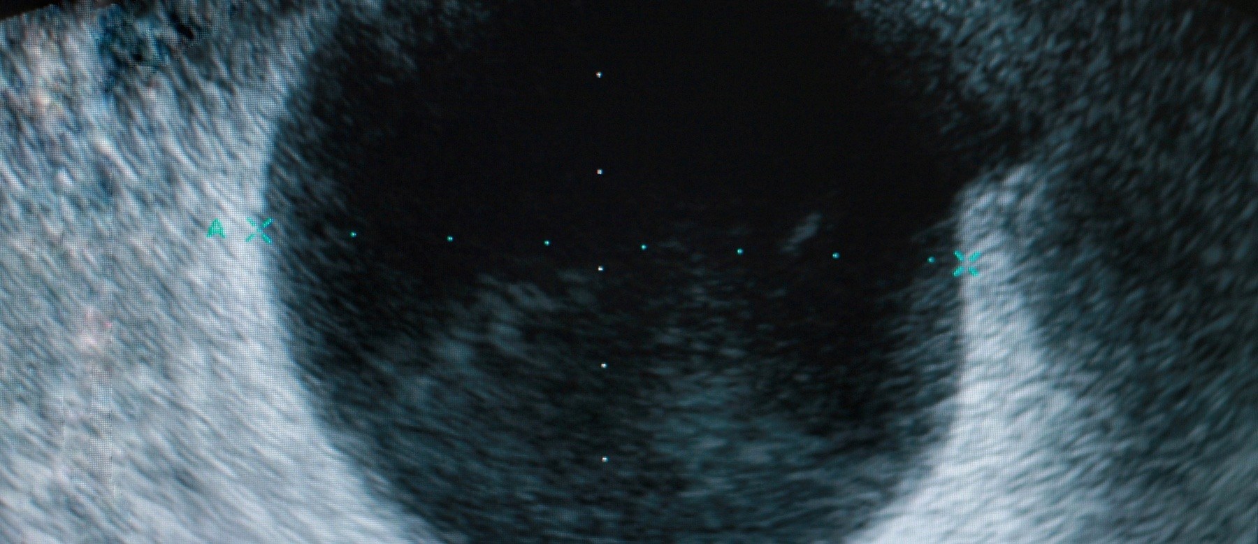 Ovarian cyst scan
